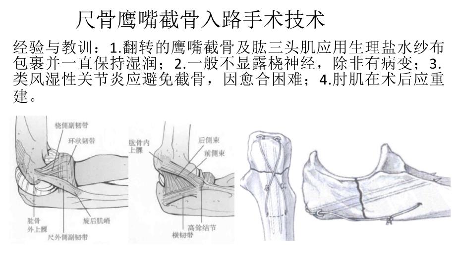 尺骨鹰嘴截骨入路解剖_第4页