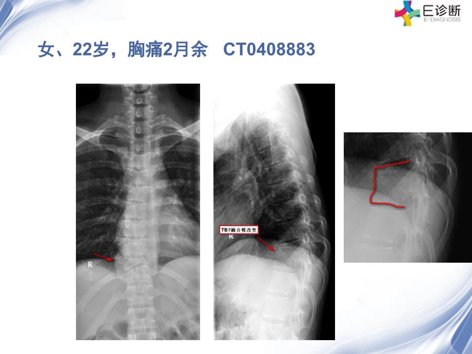 医学影像脊柱原发性恶性淋巴瘤的影像诊断_第1页