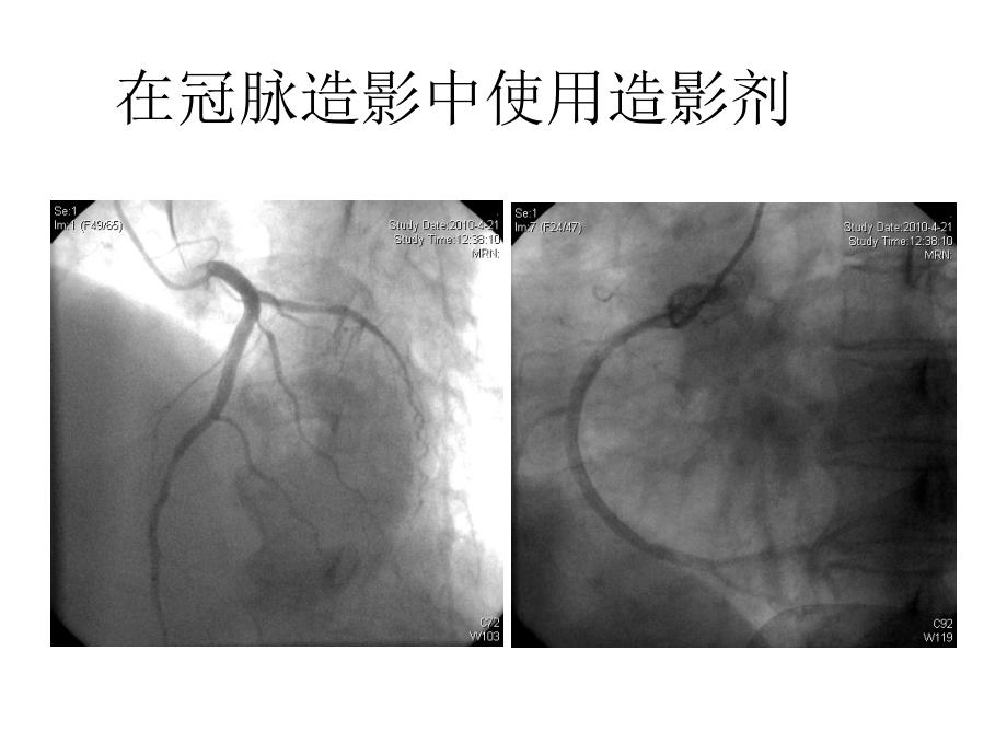 造影剂肾病预防与治疗.ppt_第2页