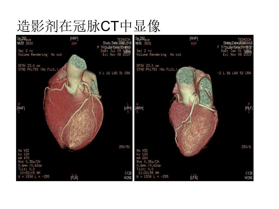 造影剂肾病预防与治疗.ppt_第3页