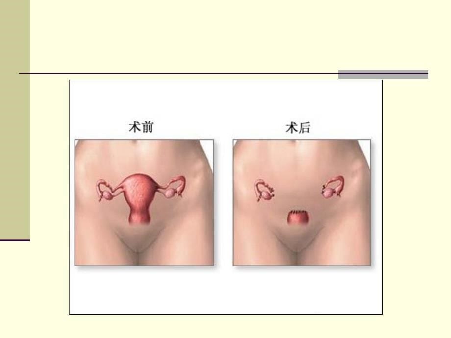 手术室护理操作——子宫切除术名师编辑PPT课件_第5页