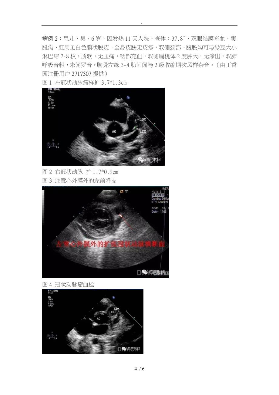 川崎病累计冠脉的超声表现_第4页