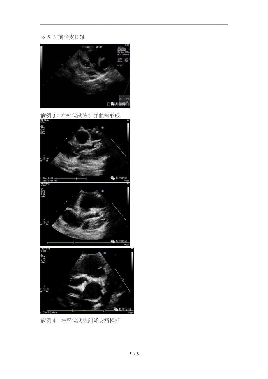 川崎病累计冠脉的超声表现_第5页