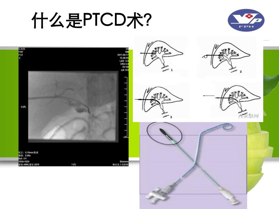 PTCD引流管的护理_第3页