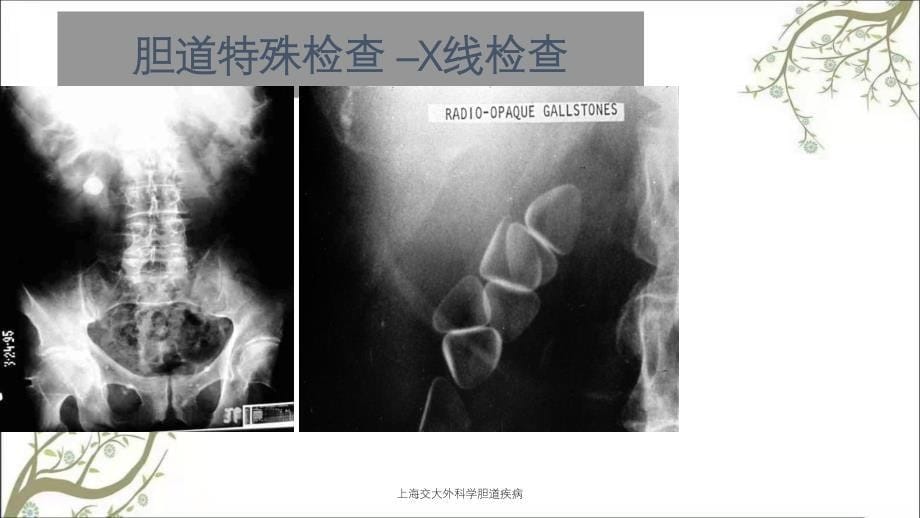 上海交大外科学胆道疾病_第5页