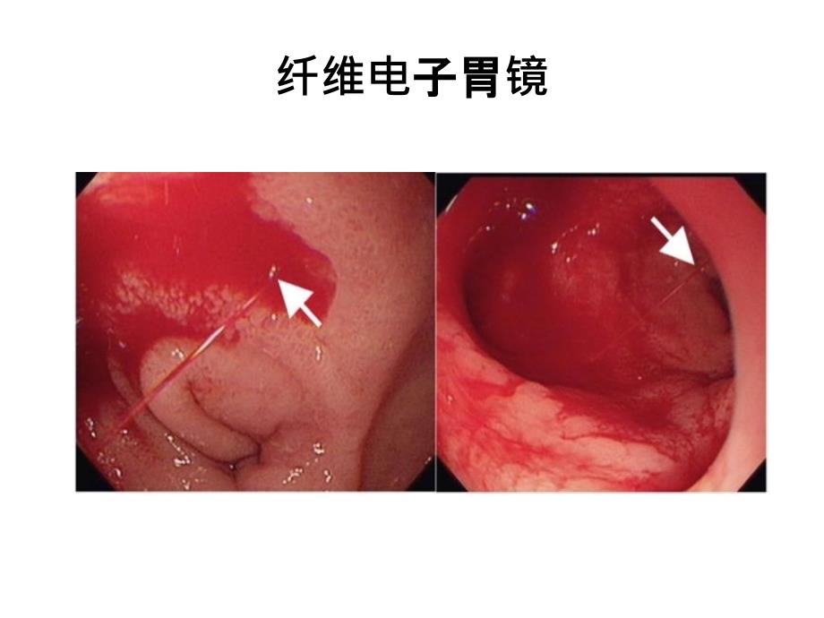 冠心病伴消化性溃疡的抗血小板治疗_第4页