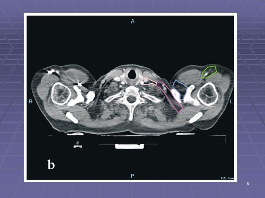 乳腺癌靶区勾画重要总结ppt课件_第5页