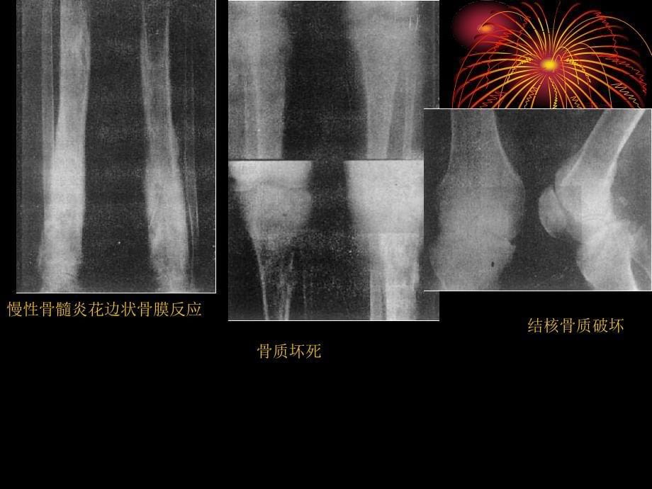 普通x线骨骼系统影像表现_第5页