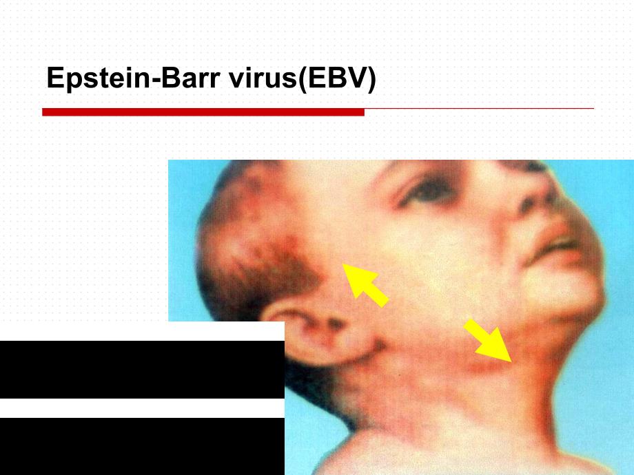 儿科学教学课件17传染性单核细胞增多症上_第4页