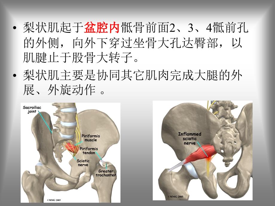 梨状肌综合征课件_第4页