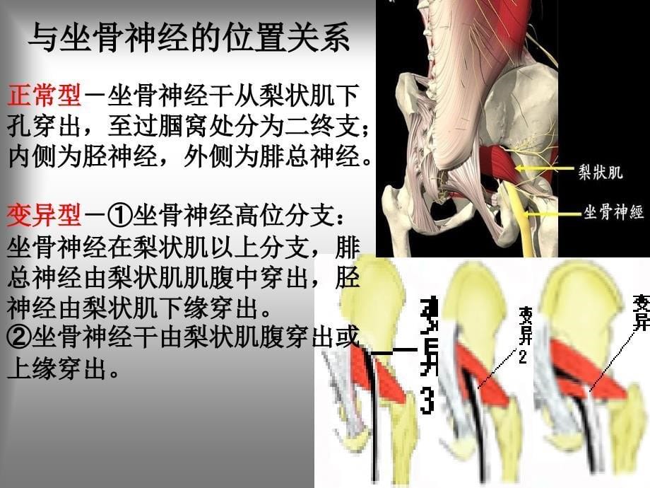 梨状肌综合征课件_第5页