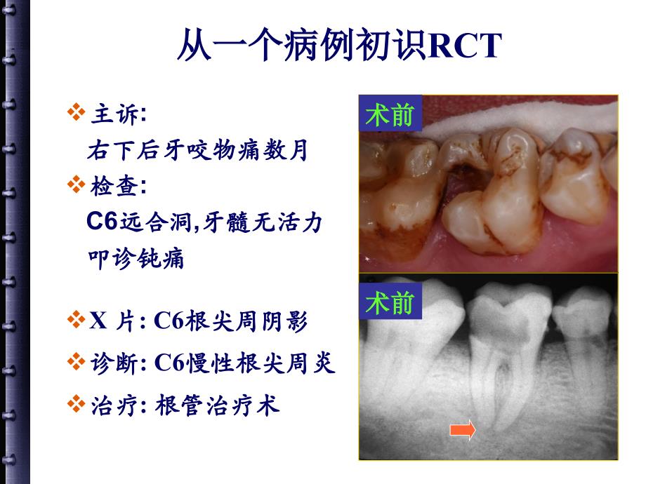 根管治疗的步骤方法器械_第4页