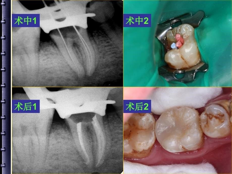 根管治疗的步骤方法器械_第5页