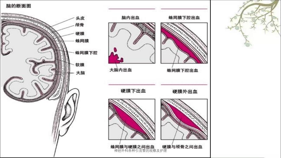 神经外科各种引流管的观察及护理_第3页