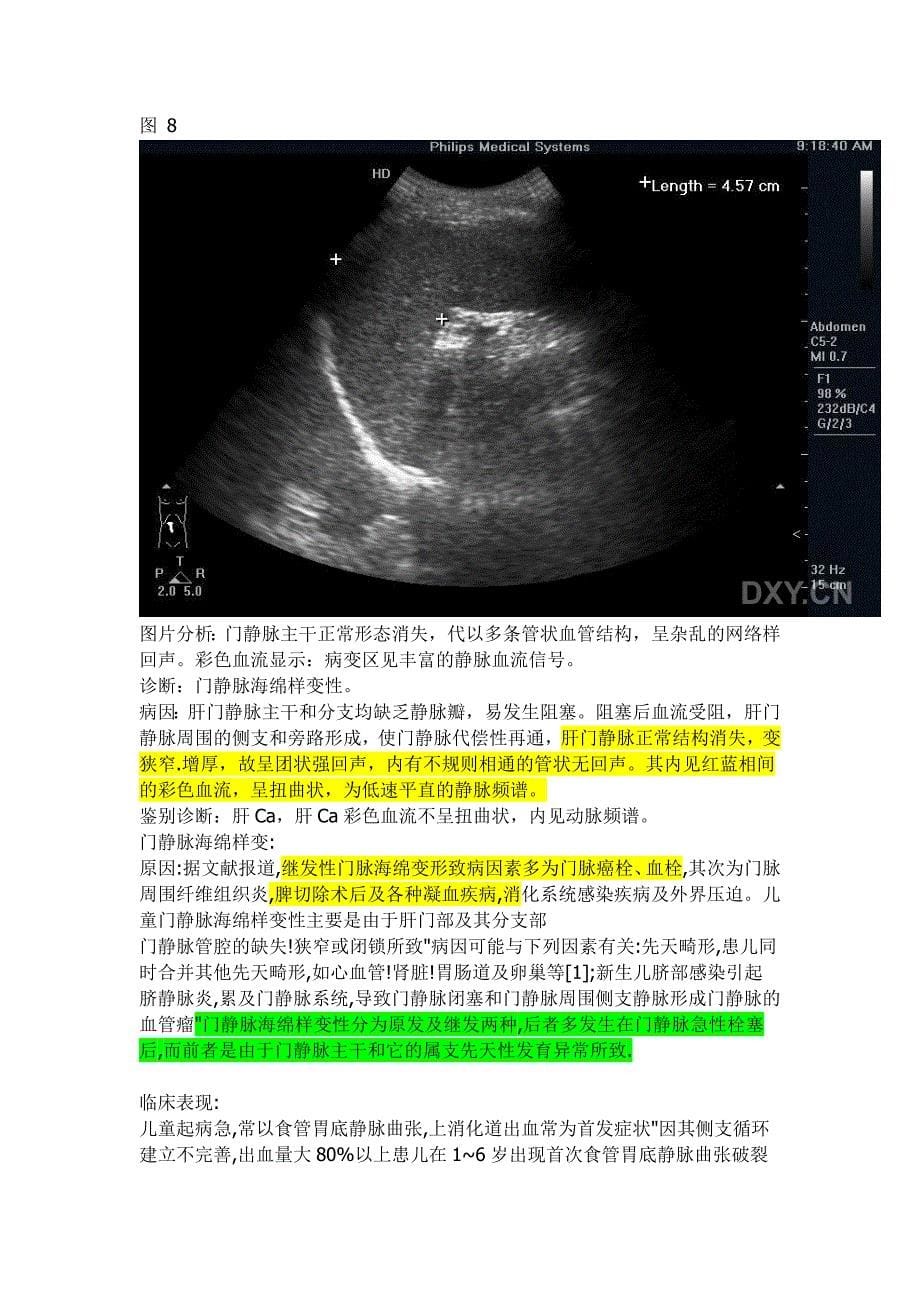 门静脉海绵样变性.doc_第5页