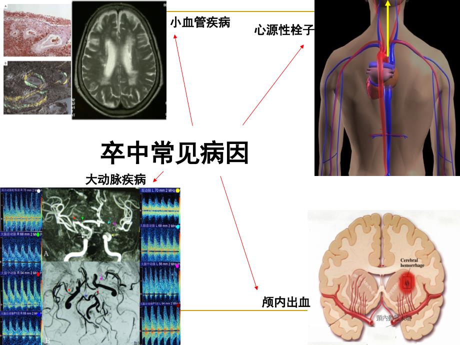 房颤患者脑卒中的防治姚哓喜1ppt课件文档资料_第3页