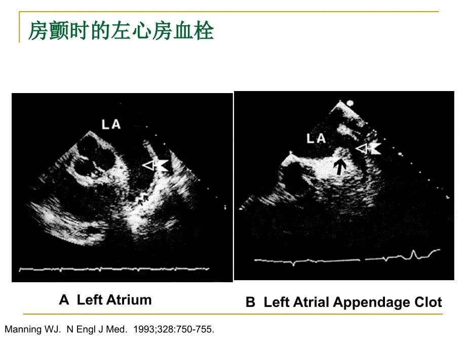 房颤患者脑卒中的防治姚哓喜1ppt课件文档资料_第5页