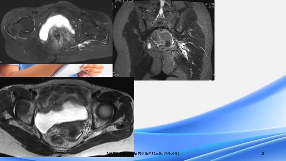 MR在梨状肌综合征的诊断中的应用课件分享_第2页