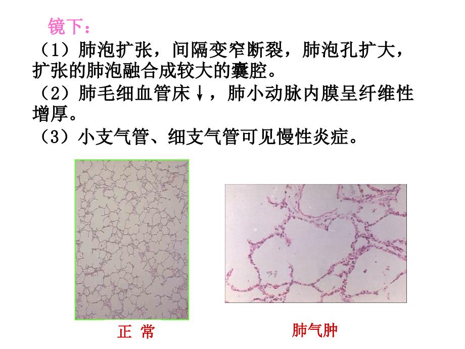 病理学慢性支气管炎、肺气肿、肺心病(下_第4页