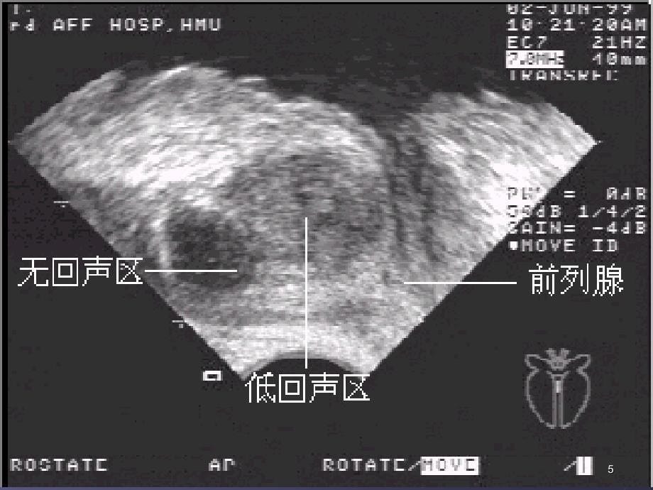 前列腺等超声诊断_第5页