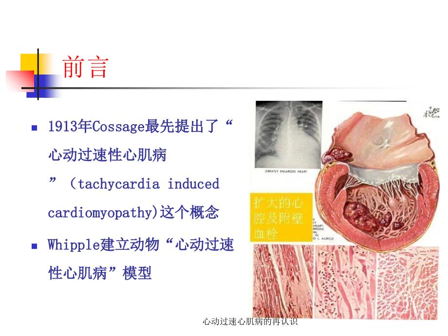 心动过速心肌病的再认识课件_第2页