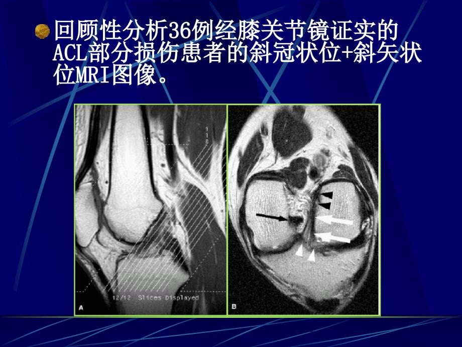 前交叉韧带部分损伤MRI诊断名师编辑PPT课件_第4页