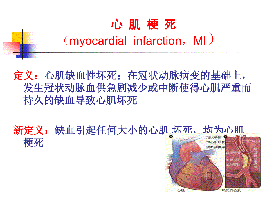 急性心肌梗死课件_第2页