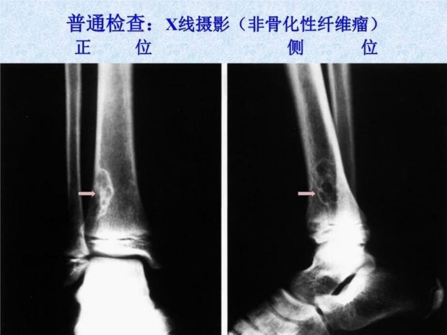 最新医学课件骨关节系统影像诊断学幻灯片_第5页