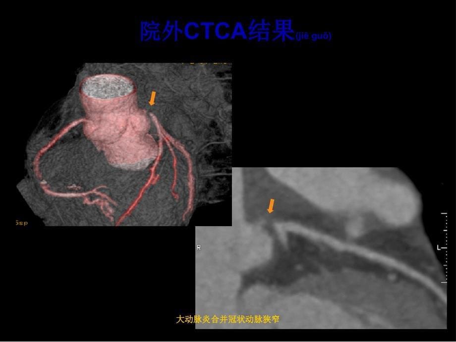 大动脉炎合并冠状动脉狭窄课件_第5页