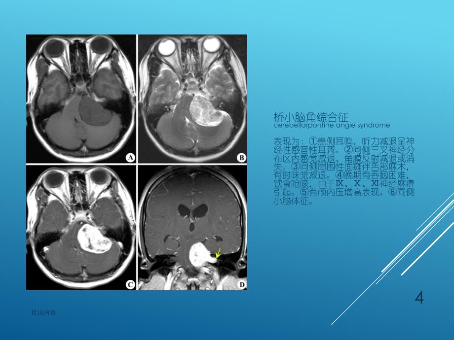 听神经瘤诊断参考材料_第4页
