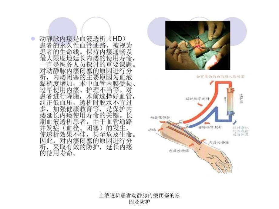 血液透析患者动静脉内瘘闭塞的原因及防护课件_第2页