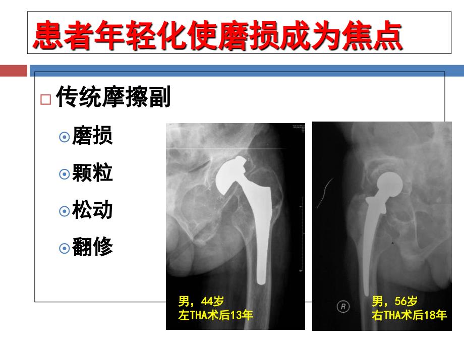 陶瓷陶瓷人工髋关节置换术手术技术_第3页