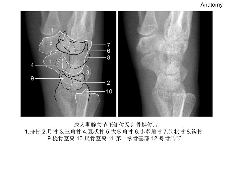 腕关节X线解剖_第4页