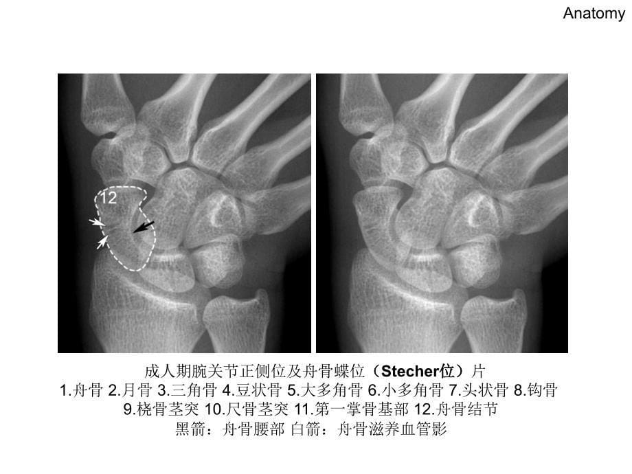 腕关节X线解剖_第5页