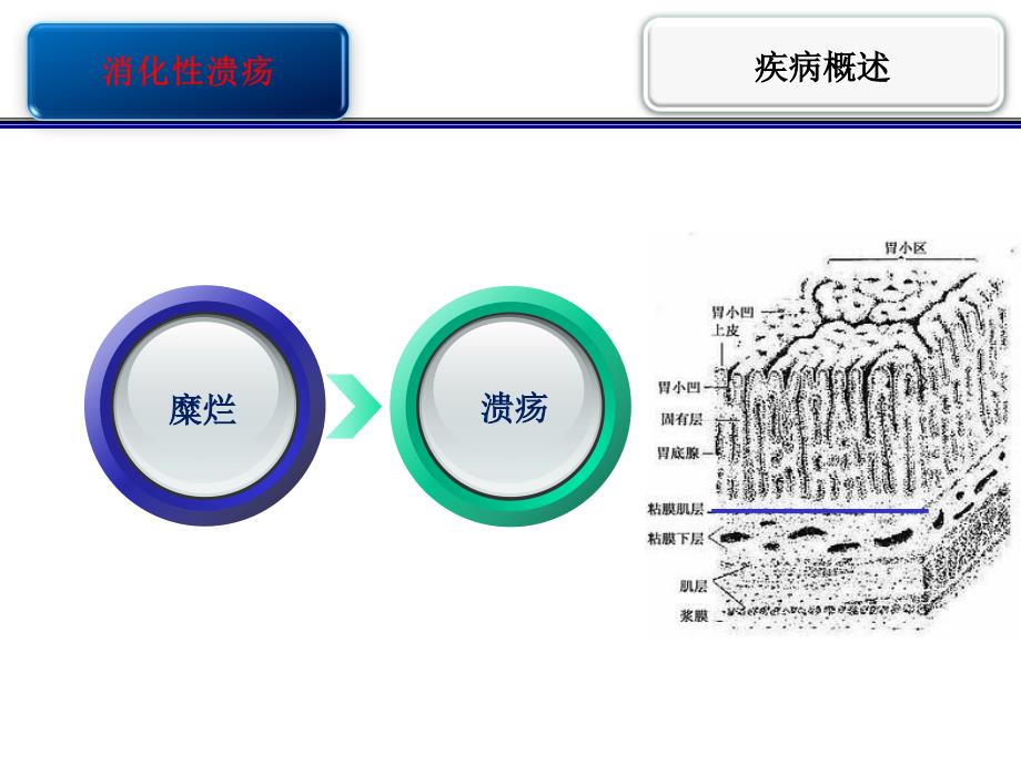 消化性溃疡护校PPT课件_第3页