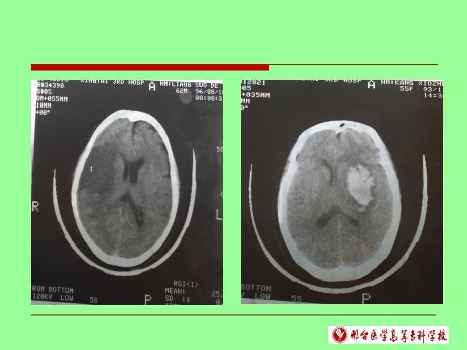 中风病的中医辨证_第5页