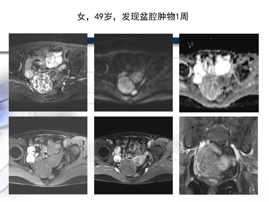 卵巢卵泡膜_-纤维瘤组肿瘤课件_第1页