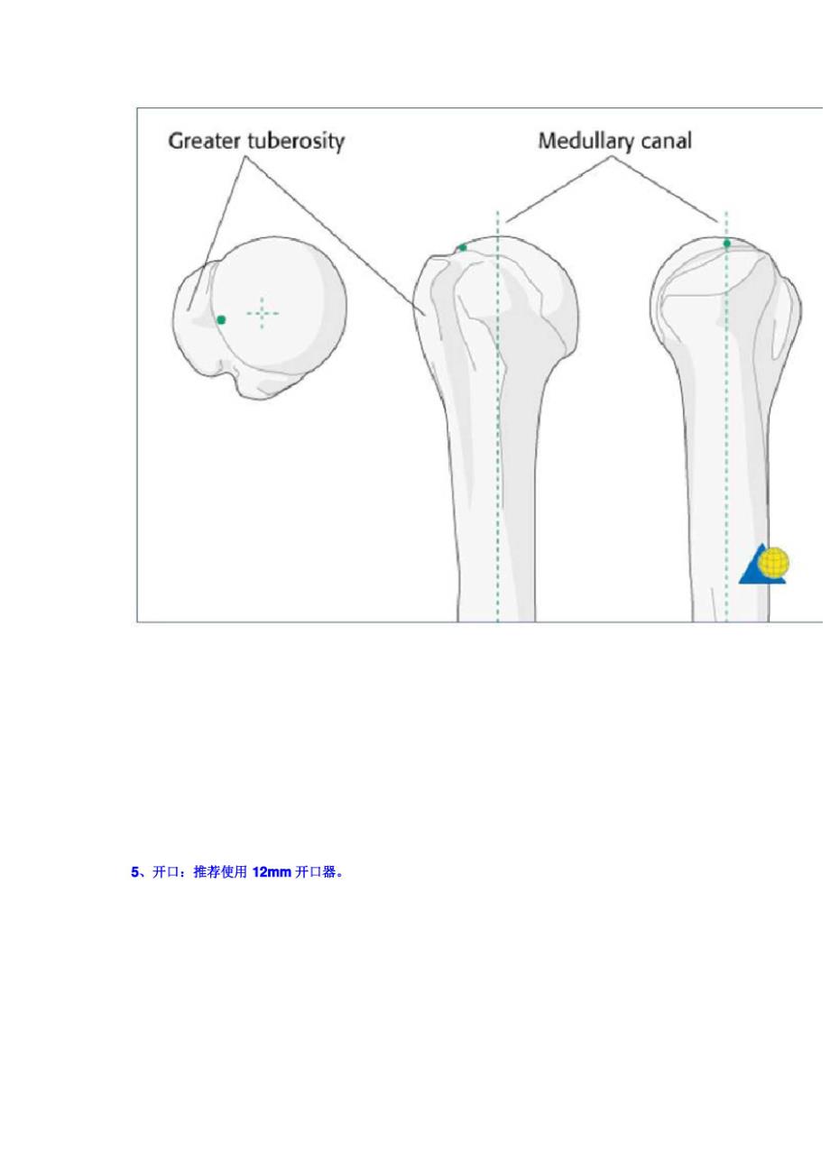 肱骨顺行髓内钉手术入路_第4页