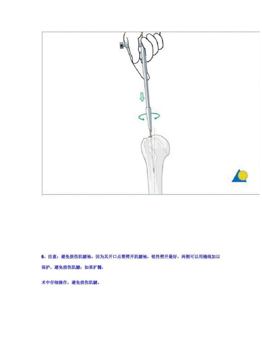 肱骨顺行髓内钉手术入路_第5页