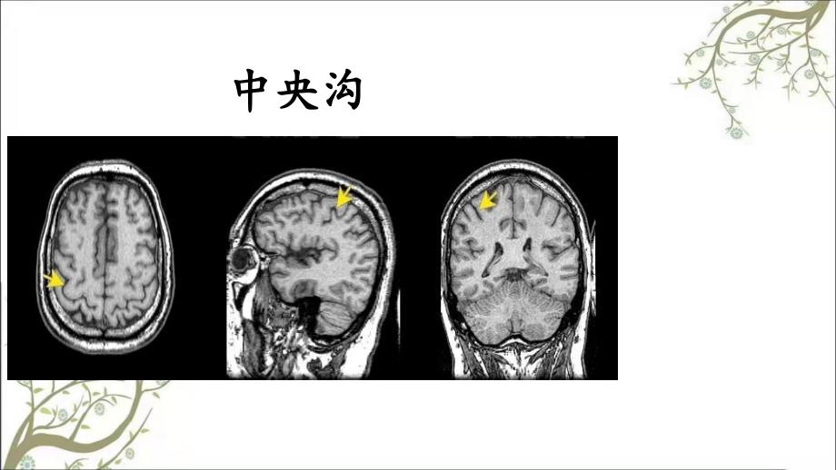 脑实质CT断层解剖课件_第4页