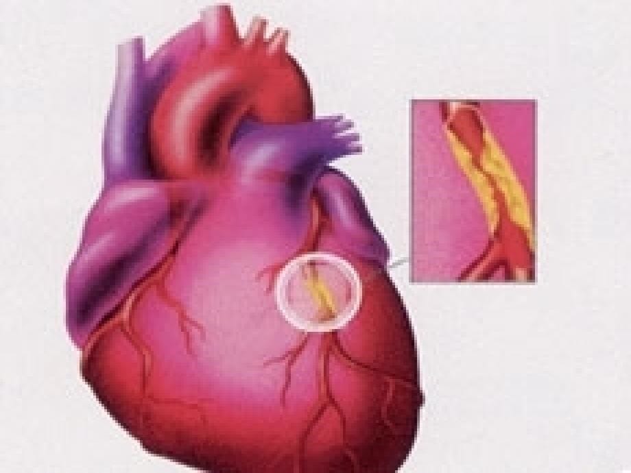 冠心病的诊治_第5页