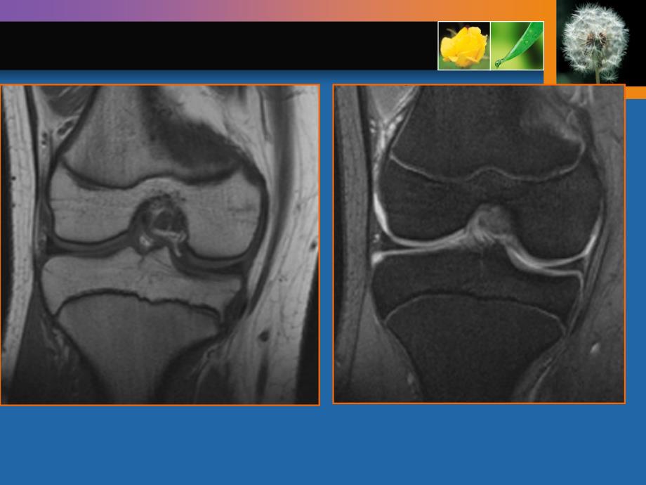 膝关节半月板及韧带损伤的MRI表现_第4页
