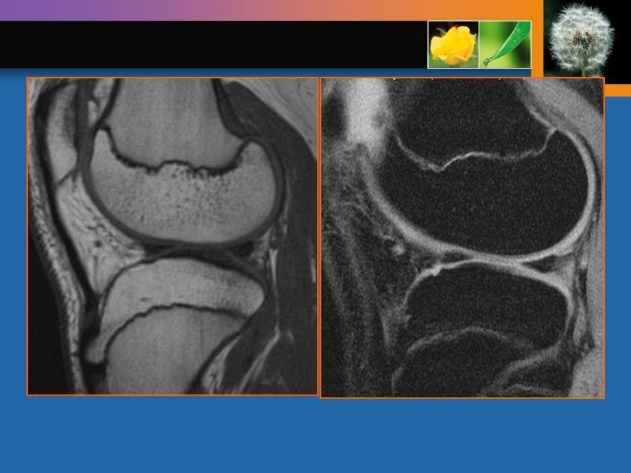 膝关节半月板及韧带损伤的MRI表现_第5页