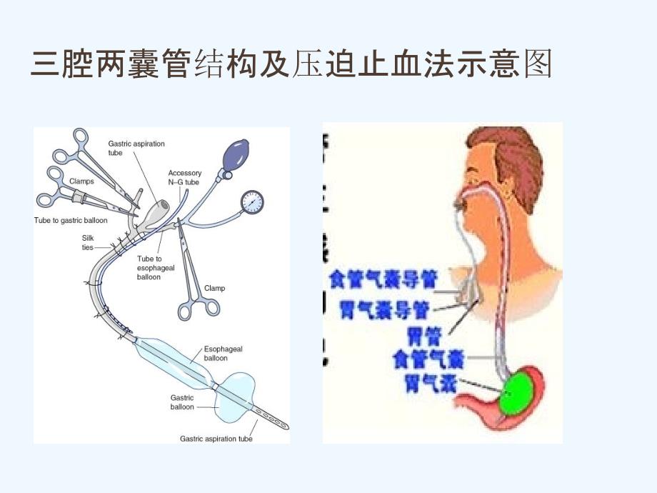 三腔两囊管及五腔三囊管压迫止血法ppt课件_第4页