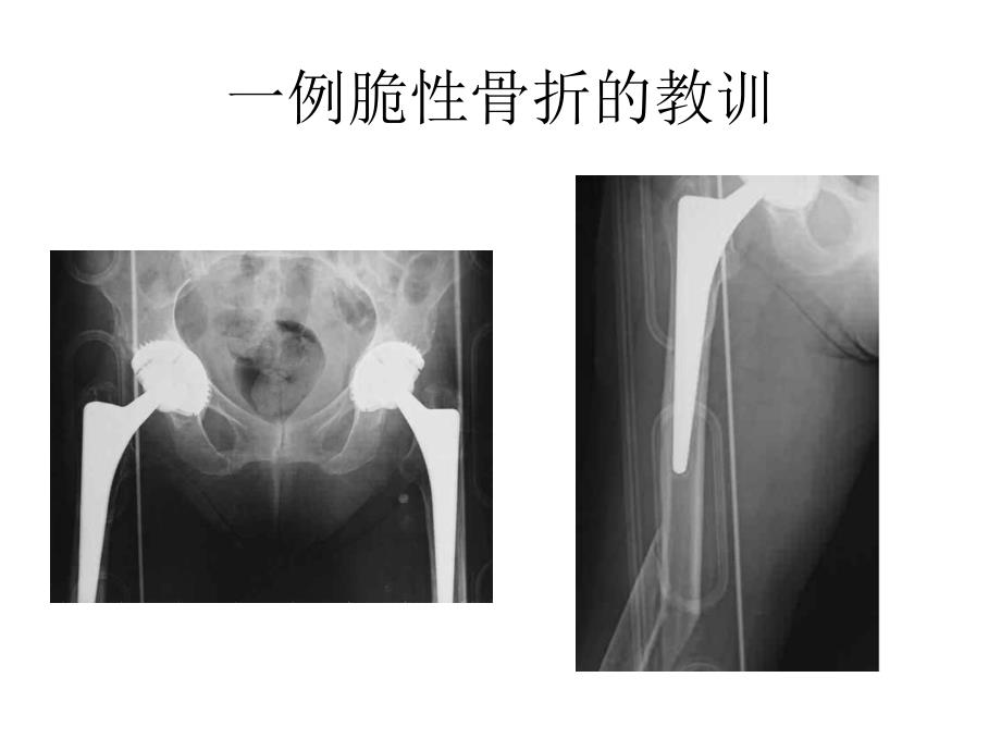 脆性骨折的医学处理.ppt_第4页