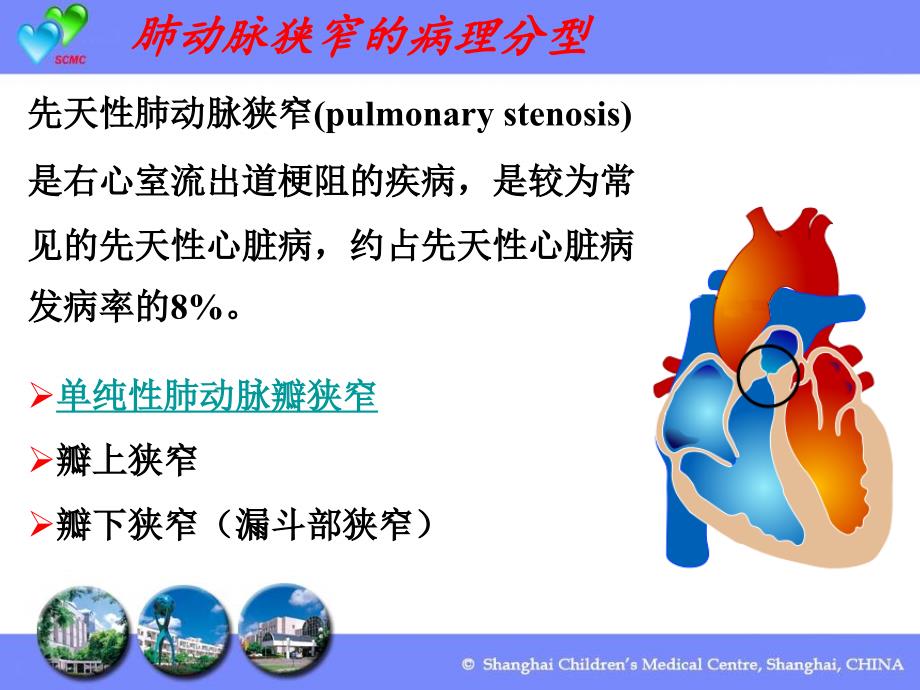 最新婴幼儿肺动脉瓣狭窄的介入治疗及疗效影响因素分析课件PPT课件_第2页