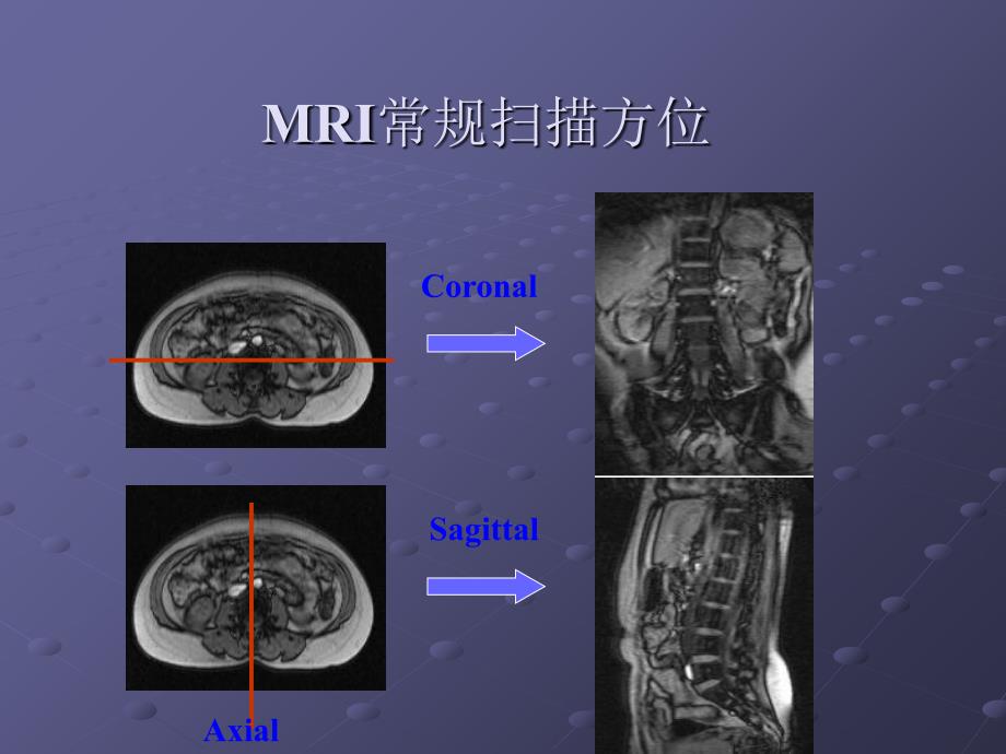 脊柱正常MRI表现及常见疾病课件_第2页