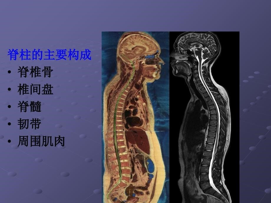 脊柱正常MRI表现及常见疾病课件_第5页