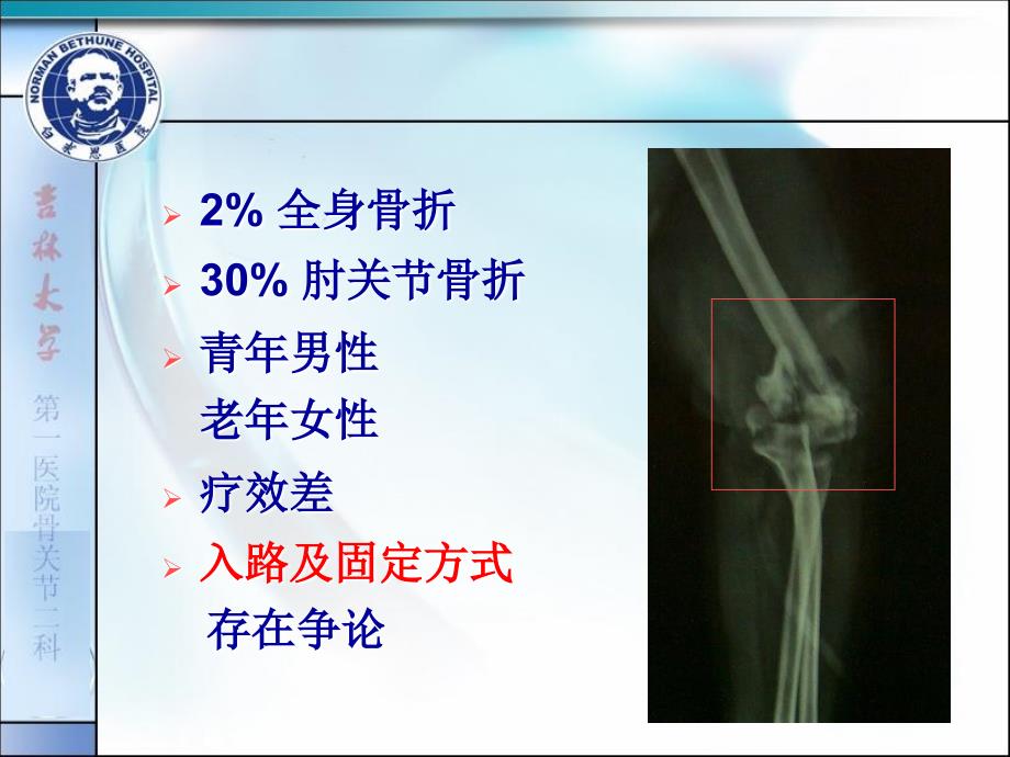 复杂肱骨远端关节内骨折手术入路及固定方式的选择_第2页