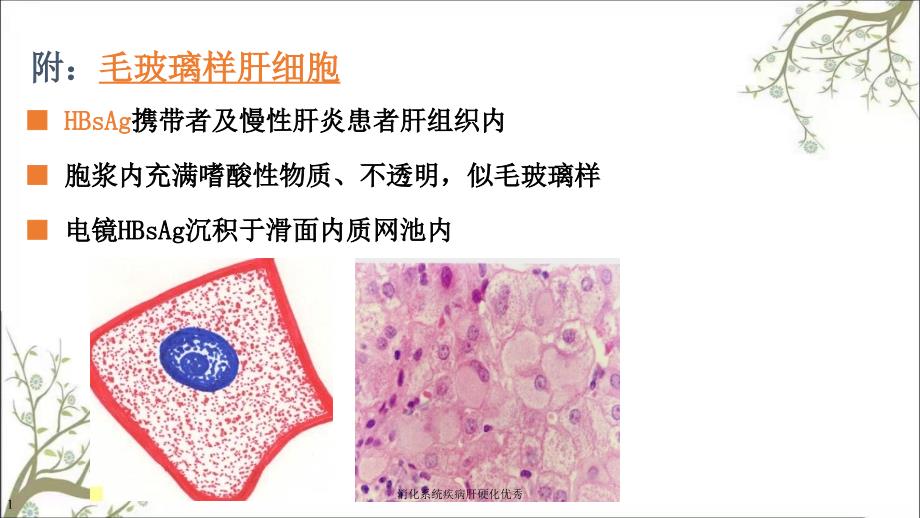 消化系统疾病肝硬化优秀_第2页